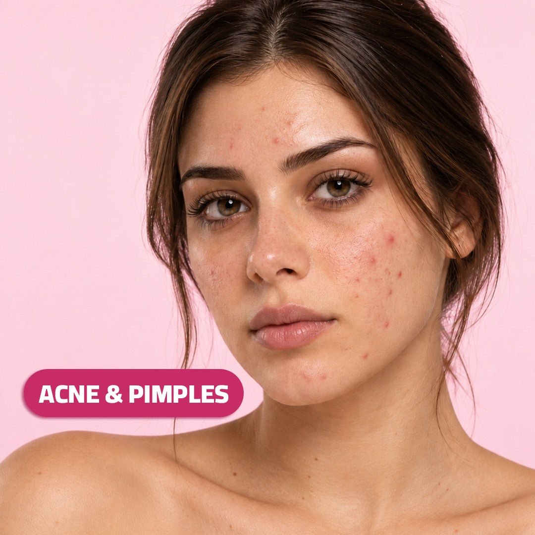 Acne & Pimples